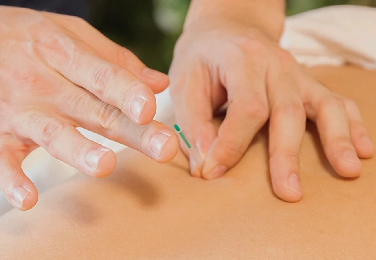Dry needling bij Fysiotherapie Bunschoten